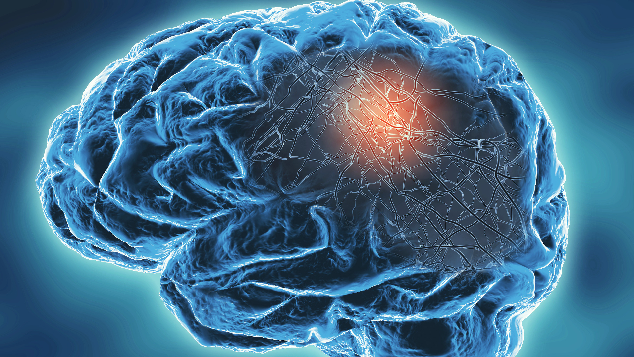 Multiple sclerosis stock image